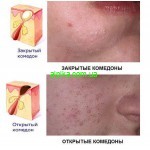 Как избавиться от комедонов?